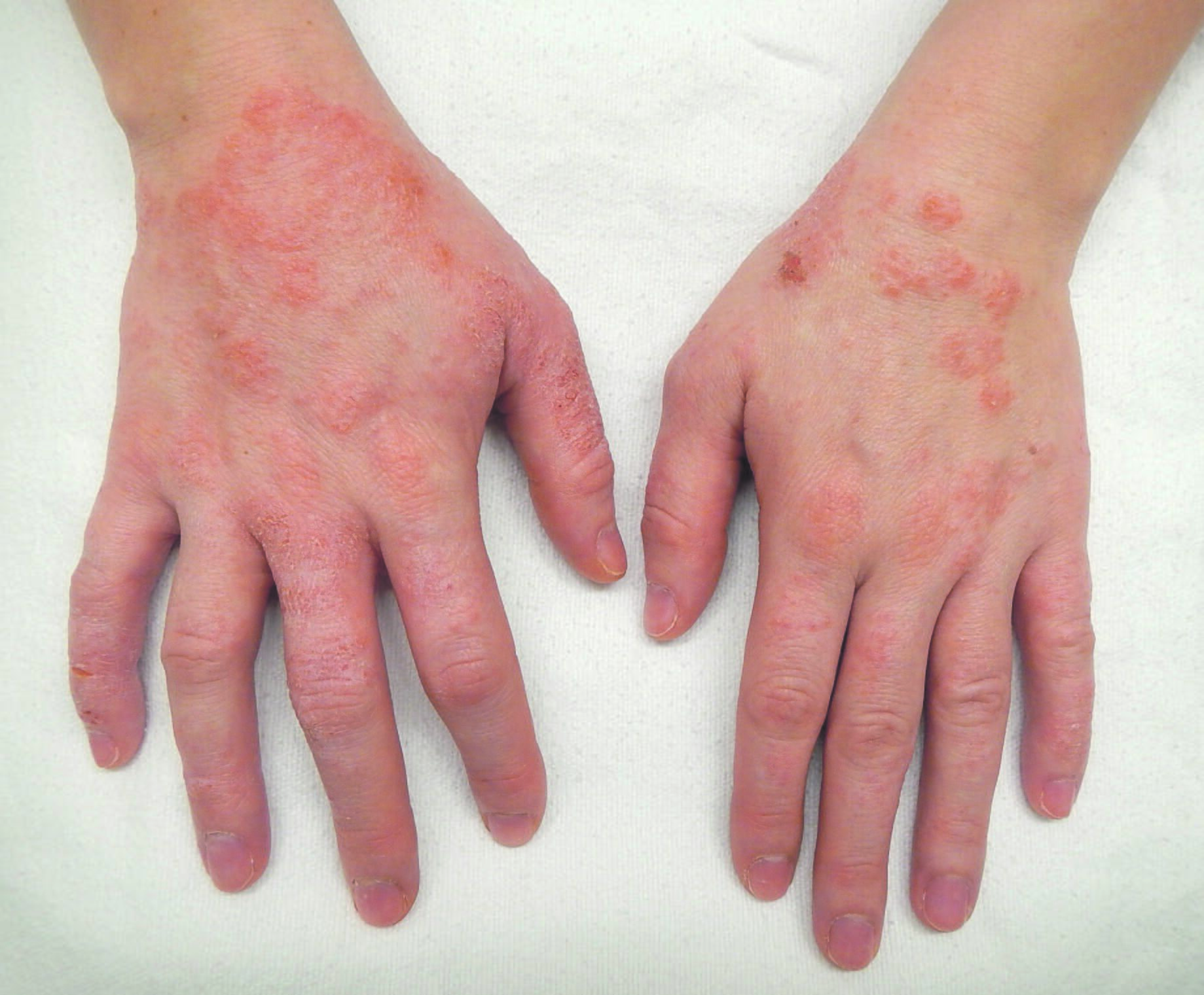 Skiriasi: sunkaus atopinio dermatito atvejais nepakanka vien vietinio poveikio priemonių – reikalingas sisteminis gydymas, apimantis viso organizmo imuninės sistemos reguliavimą.