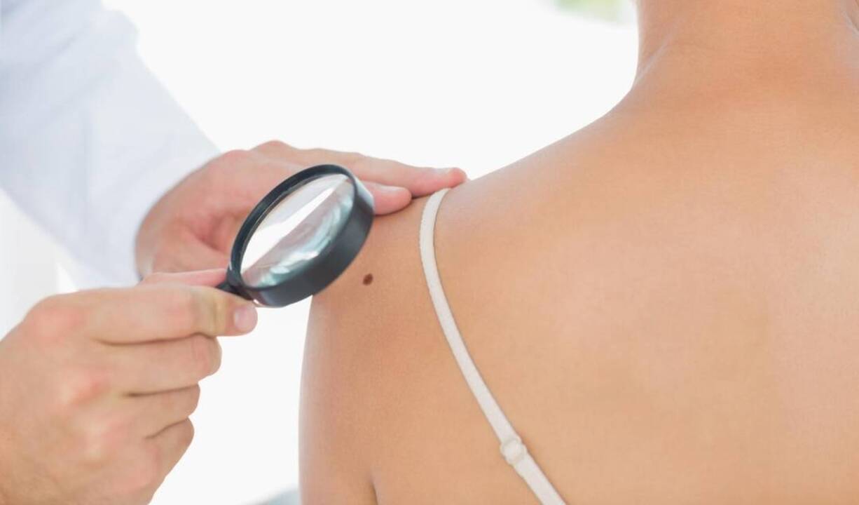Odos vėžys kasmet paliečia vis daugiau gyventojų: šiuos požymius gali pastebėti ir pats pacientas