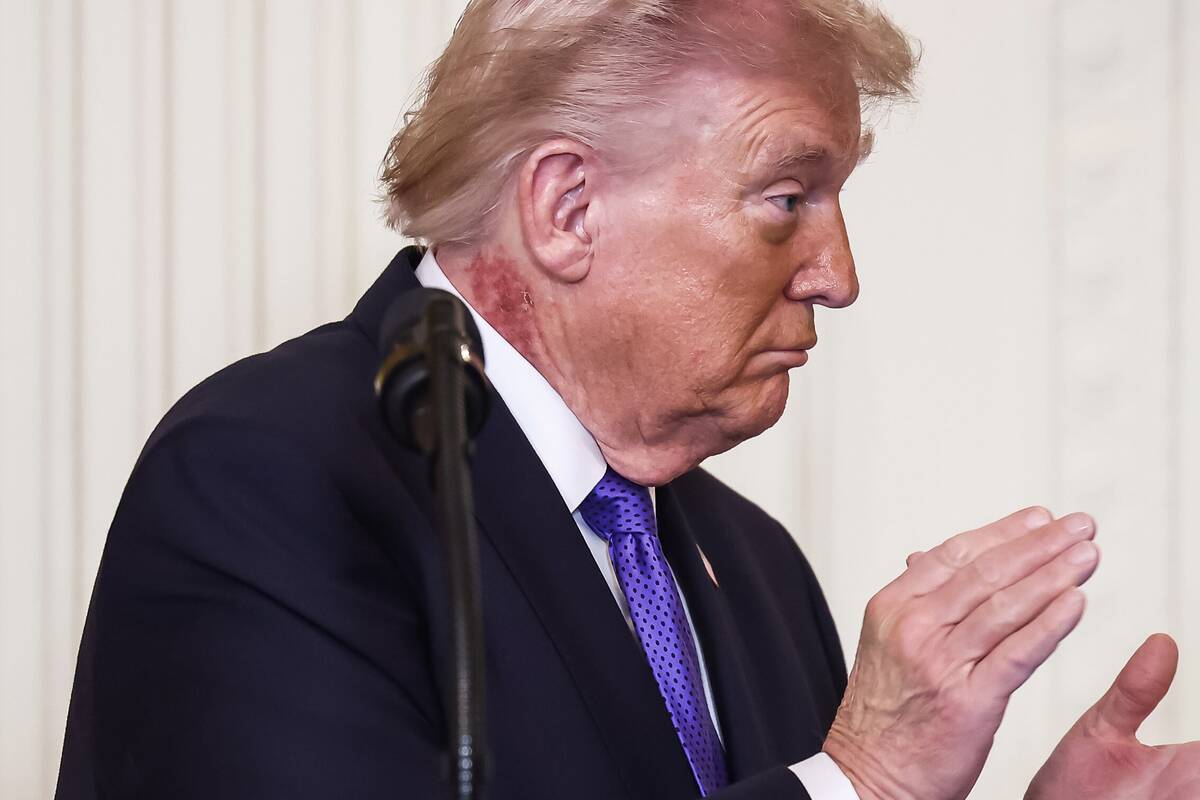 
<span>Spėliojama apie JAV vadovo sveikatos būklę: kas nutiko Trumpo kaklui?</span>
