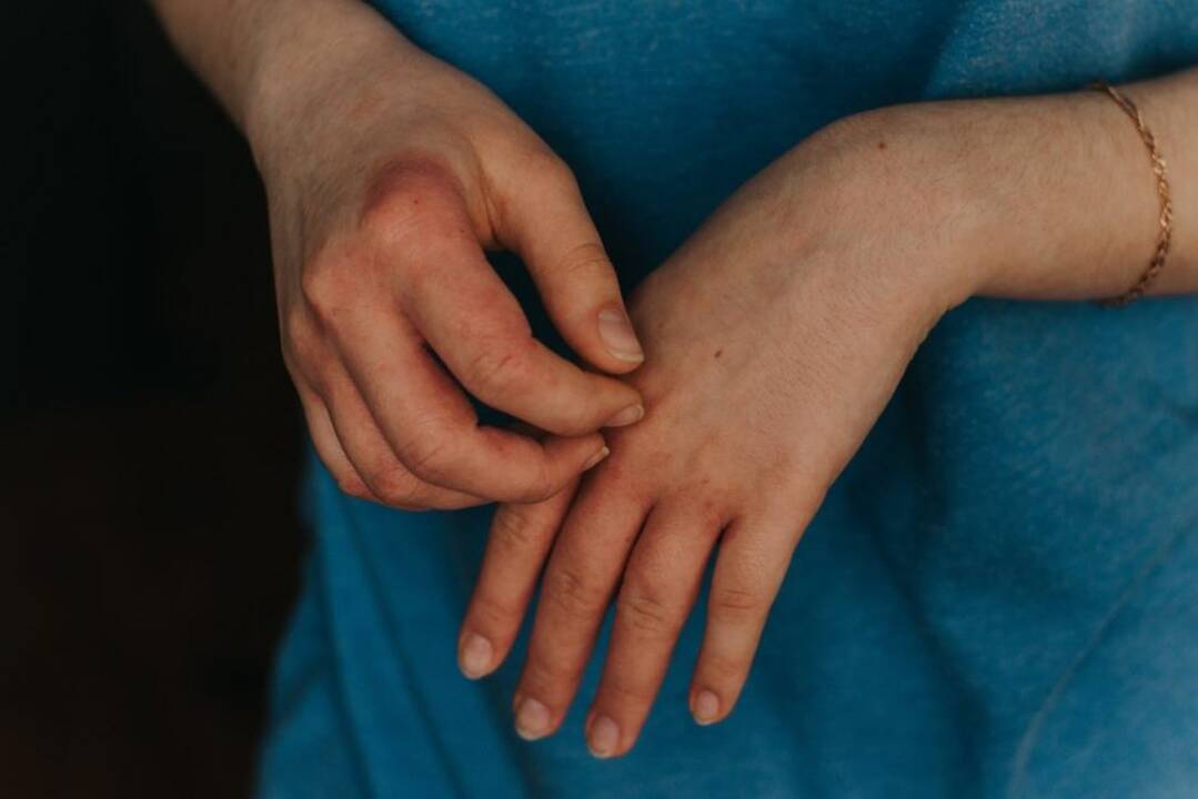 Vokietija svarsto priemones užkirsti kelią beždžionių raupams