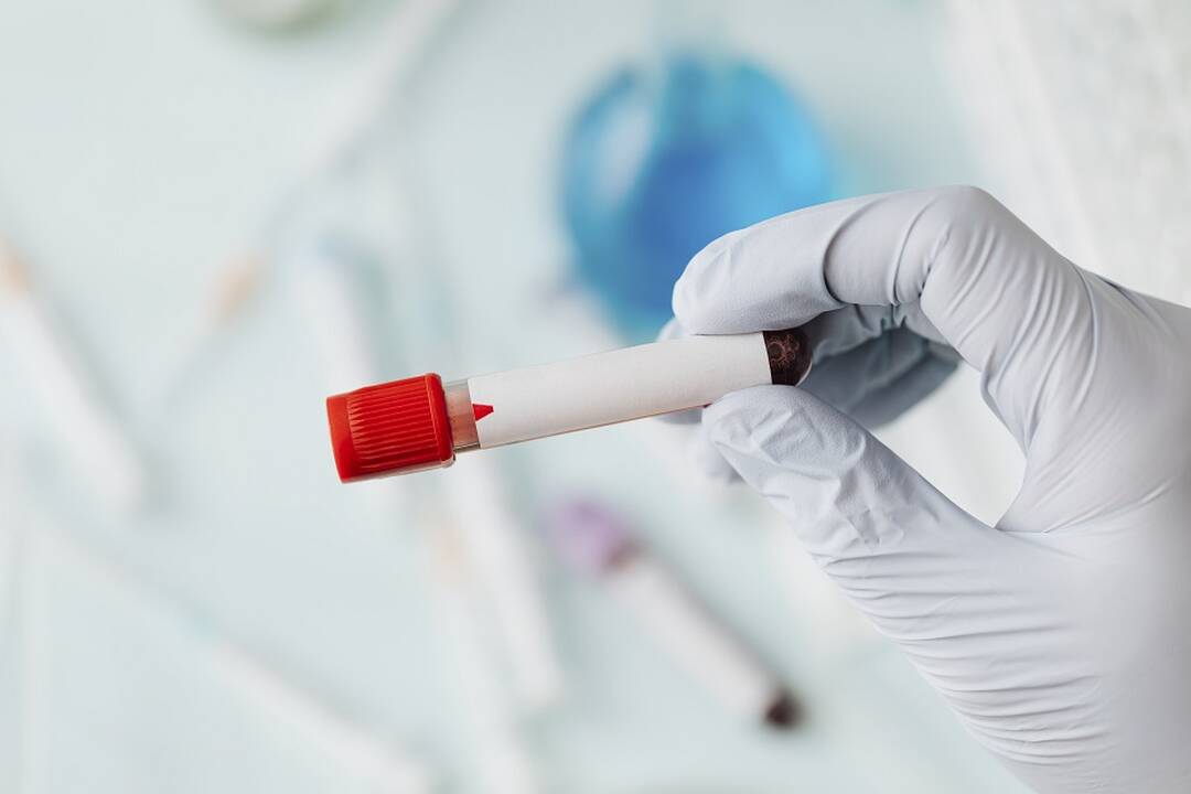 COVID-19 statistika Lietuvoje: nustatyti 89 nauji atvejai, mirė trys žmonės 