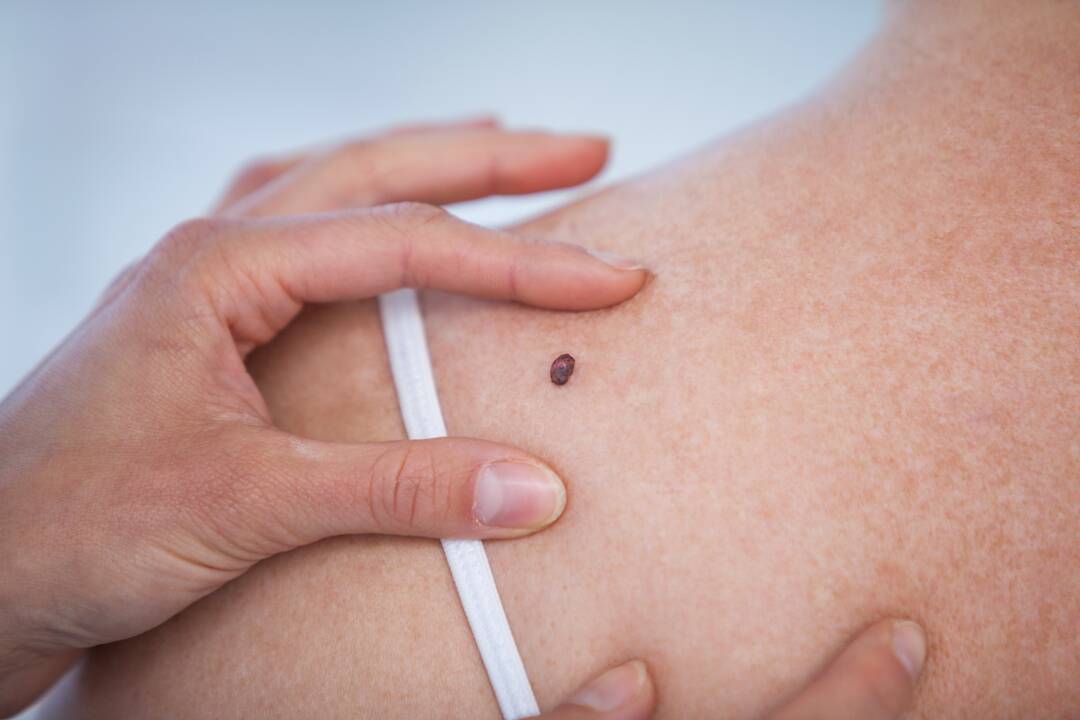 Melanoma gali išsivystyti įgimtame apgame arba šalia jo, darinys gali tarsi iš karto atsirasti odoje, didėti, kisti forma ir spalva, imti kraujuoti.