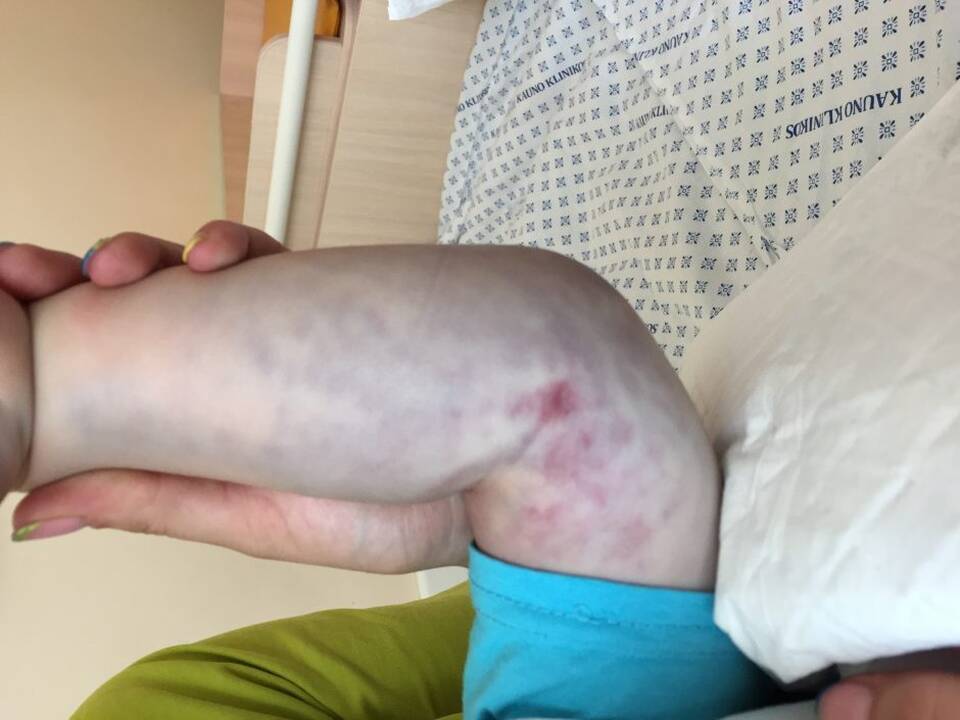 Ligoninėse – vaikai, kuriems įkando gyvatės: ką daryti ir ko – ne