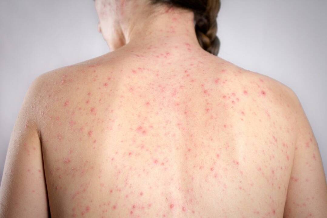 Grįžta seniai pamirštas virusas: užsikrėsti pakanka vos penkiolikos minučių