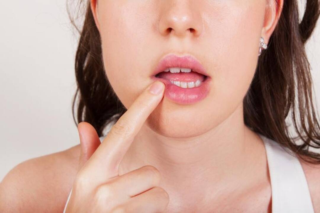 Kuo Herpes virusas kelia pavojų gyvybei? (gydytojo komentaras)
