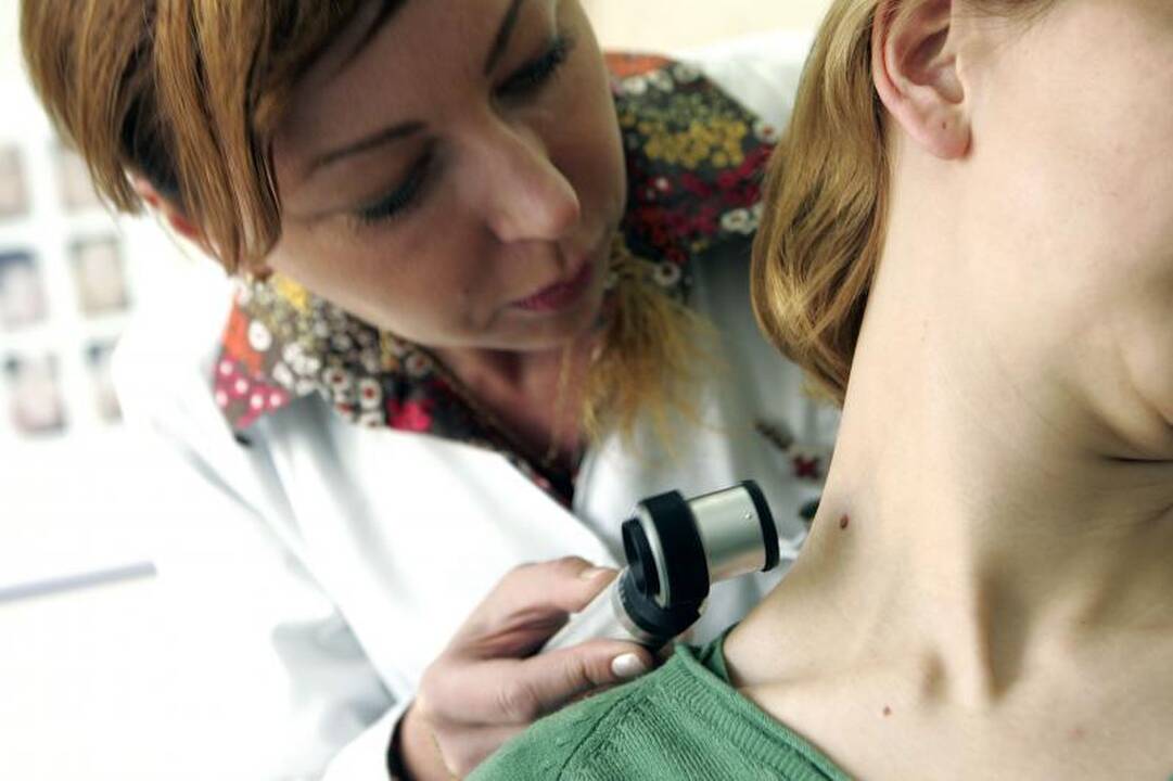 Nemokamai pasitikrinti dėl melanomos galima ne tik per akciją