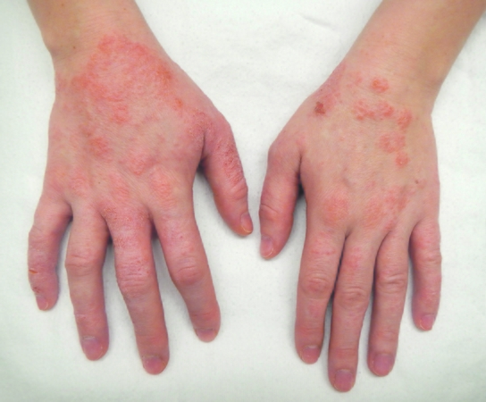 Skiriasi: sunkaus atopinio dermatito atvejais nepakanka vien vietinio poveikio priemonių – reikalingas sisteminis gydymas, apimantis viso organizmo imuninės sistemos reguliavimą.