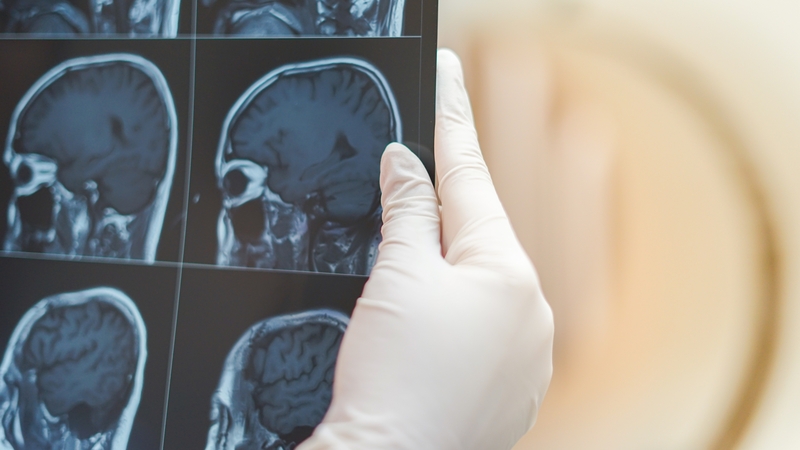 Mintys virto balsu: smegenų implantas sugrąžino vyrui galimybę kalbėti