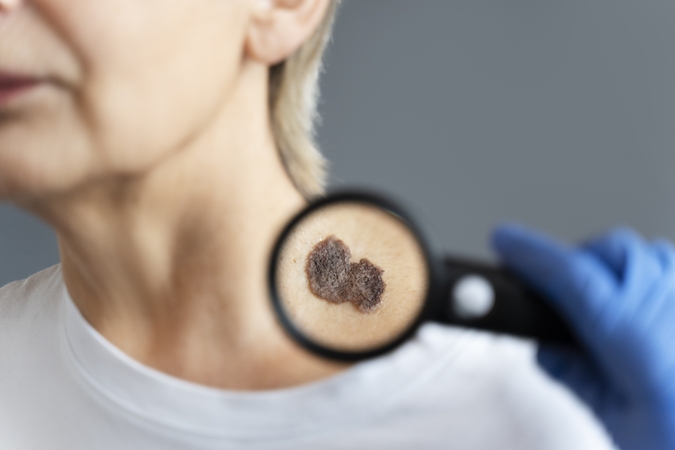 Revoliucija onkologijoje: „Moderna“ melanomos vakcina sėkmingai praėjo didelio masto tyrimus