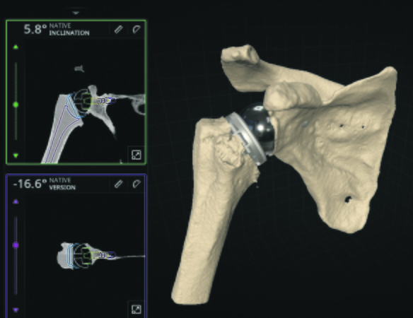 Modeliuoja: medikų teigimu, operaciją planuojant pasitelkus inovatyvius 3D modelius, galima tiksliai įvertinti paciento anatominius ypatumus ir parinkti tinkamiausią implantą.