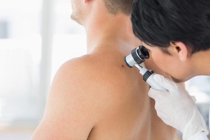 Lietuvoje kasmet nustatoma apie 200 melanomos atvejų