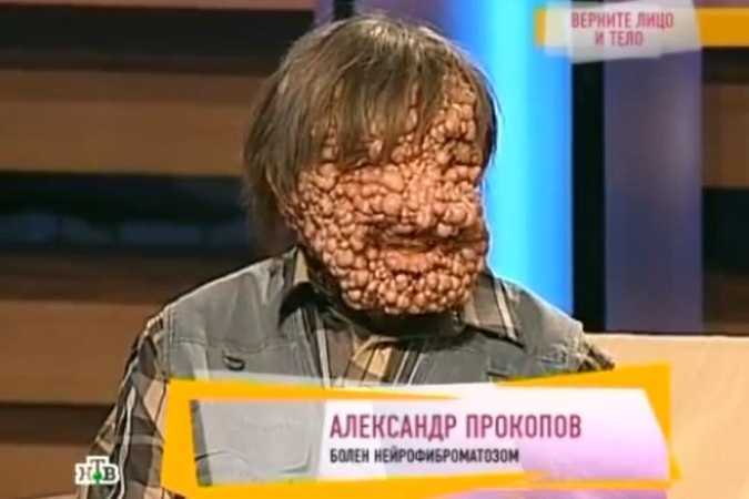 Reta liga vyrą pavertė panašų į siaubo filmo personažą 