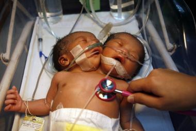 Filipinuose gimė kūdikis su dviem galvomis